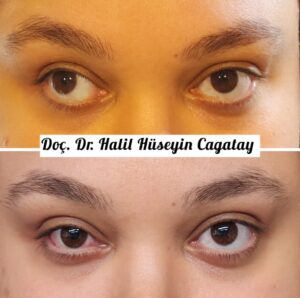 corrective-surgery-for-lazy-eye